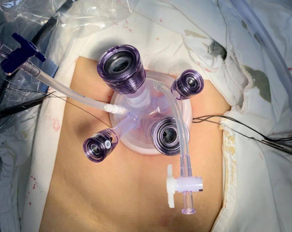 该如何抉择?术后"无痕",经脐单孔腹腔镜技术助力妇科手术治疗!