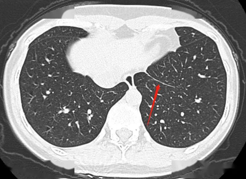 胸部ct上的"肺韧带",别再报纤维条索了_影像_纵隔_解剖图