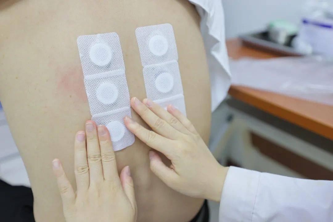 "三伏贴"是中医"冬病夏治"中