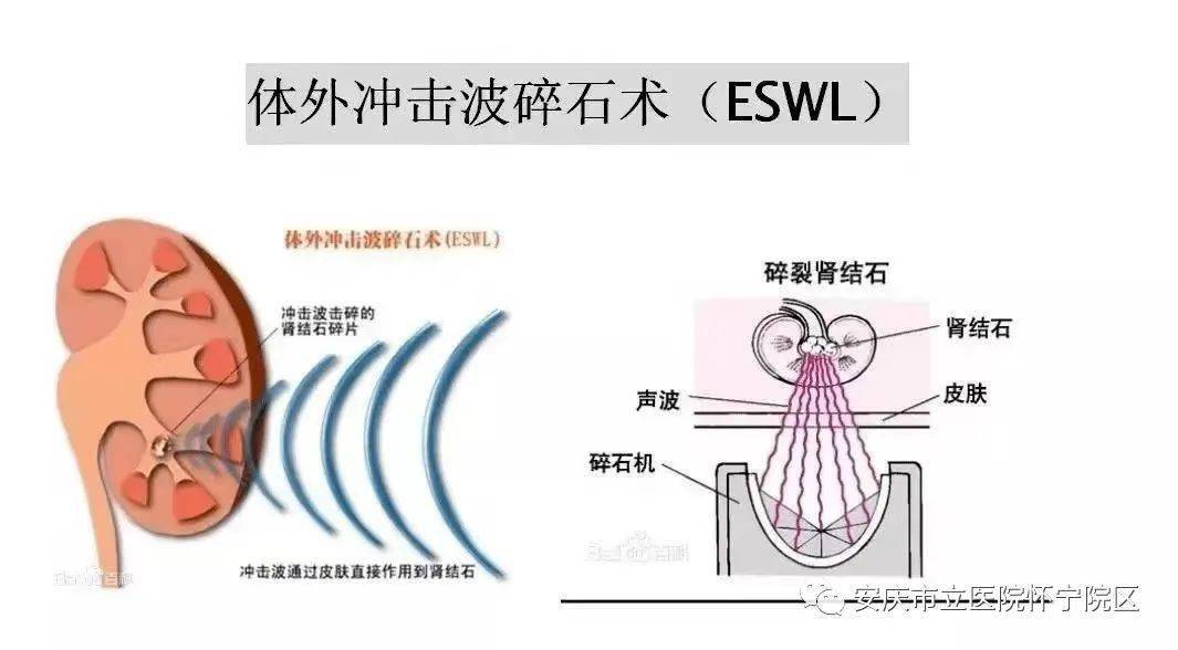 精准碎石丨县医院引进新一代体外冲击波碎石机,为泌尿系结石诊治再添