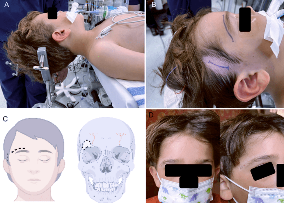 【精选编译】眶上入路置入ommaya囊治疗儿童颅咽管瘤_研究_患者_肿瘤