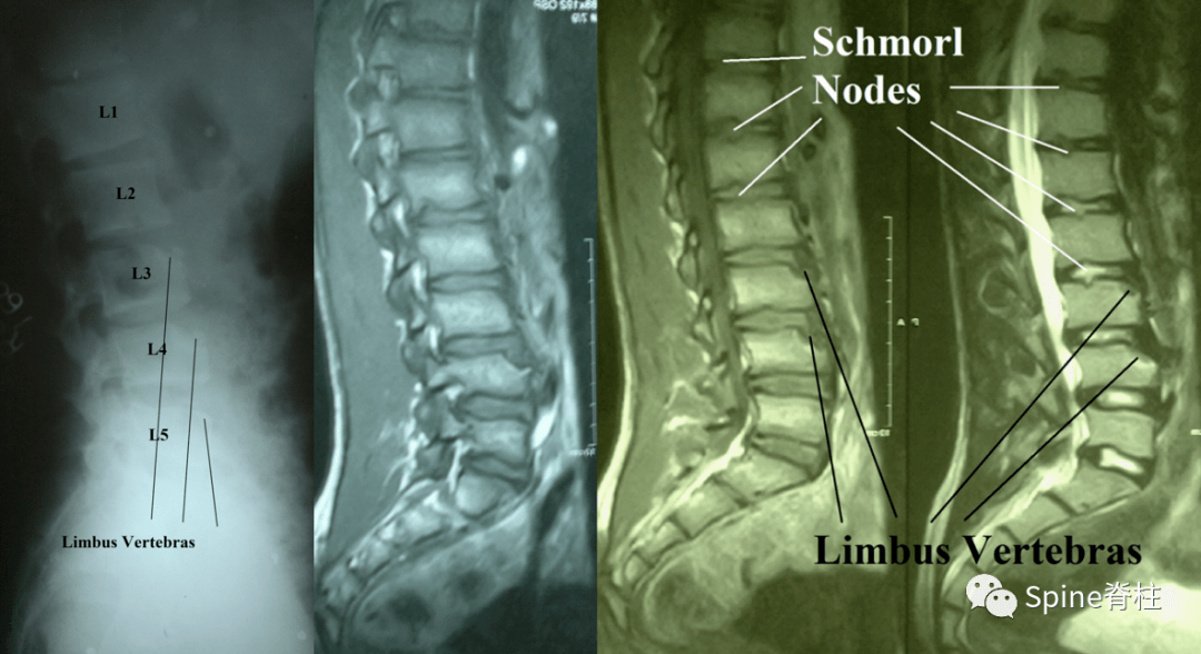 腰椎側位片提示l3-l5椎體前緣缺損,mri提示椎體前緣缺損和多發許莫氏