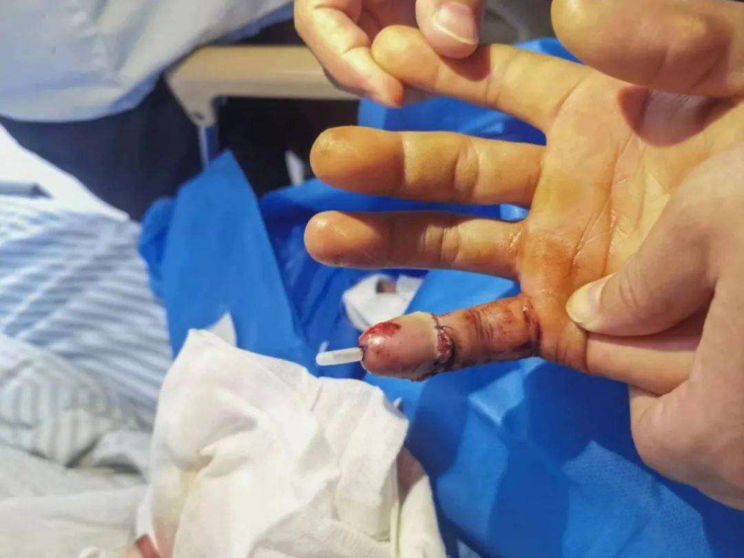 我院骨一科再次成功接活两例断指