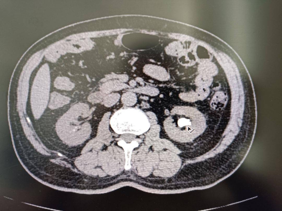 患者:64岁男性,ct显示左肾结石位于肾下盏内,结石体积较大(结石直径