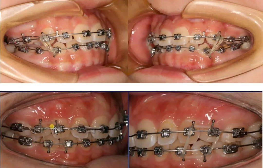 牙齿矫正三类牵引图片图片