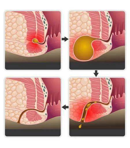 轻微肛瘘图片硬块图片