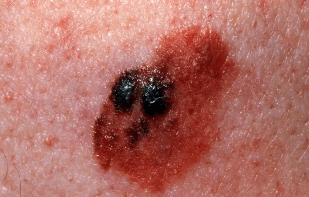 另外,如果痣的周围出现小痣,有可能是卫星痣,也有可能是恶变的表现.