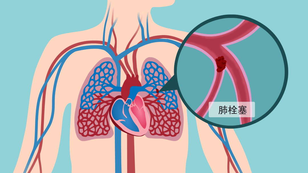 肺栓塞是指静脉里面血流淤滞,形成了血块,脱落后随血流到心脏和肺动脉
