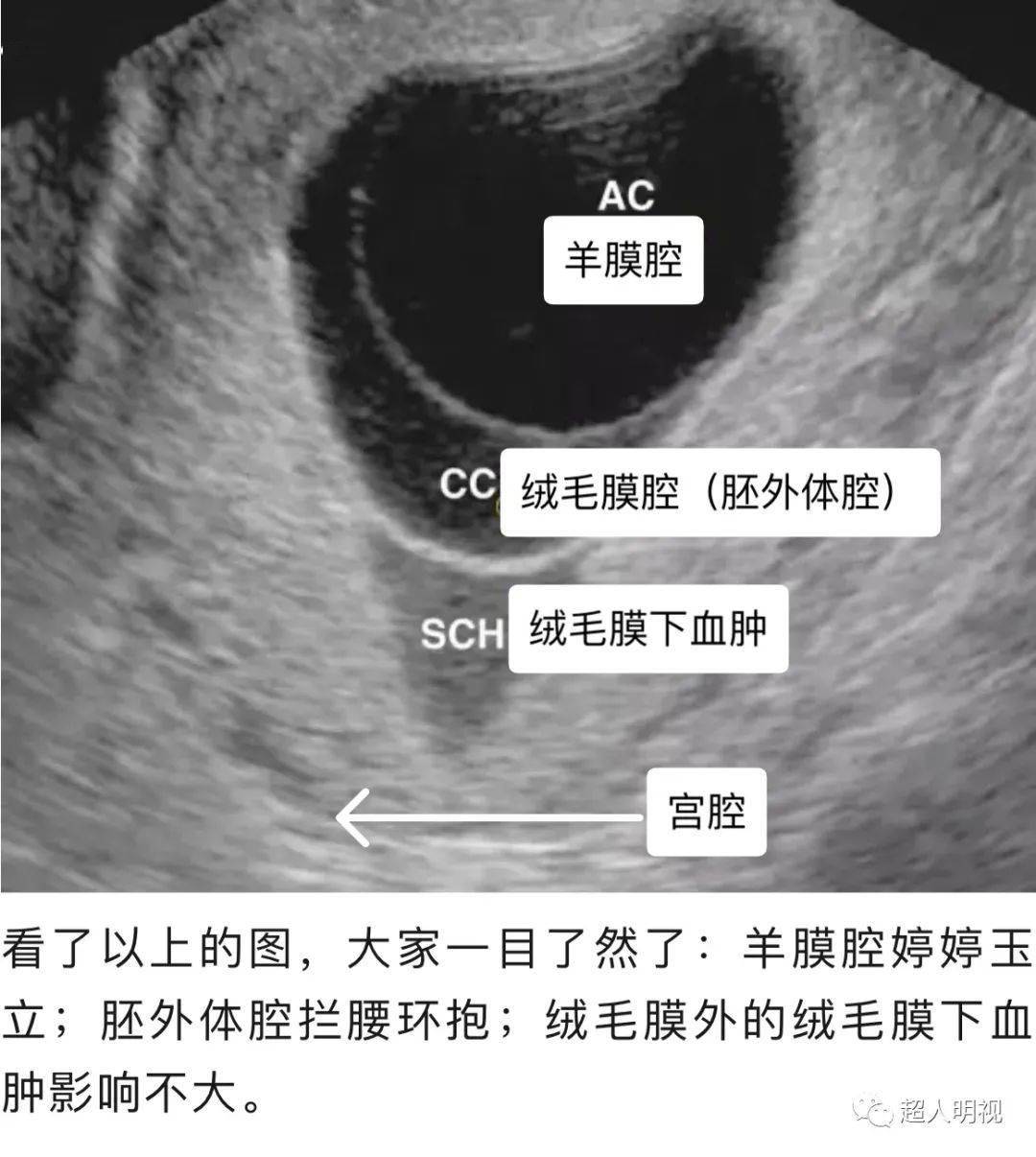 再看几张图:以下是绒毛膜下血肿宫内早孕合并宫腔少量积液和节育环下