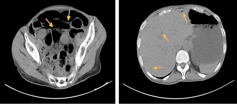 腹部增强ct扫描显示胃显著扩张,多发小肠袢扩张伴气液平,回肠壁积气