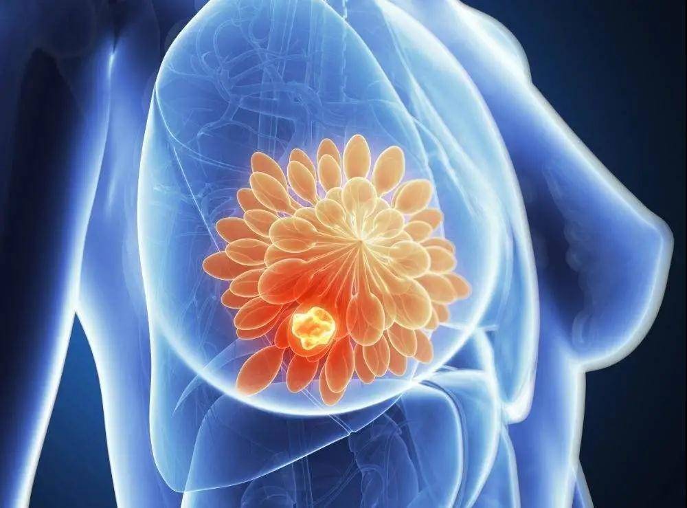 乳腺癌早期能治愈吗图片