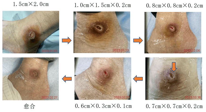 案例:一例左外踝部不可分期压力性损伤的护理