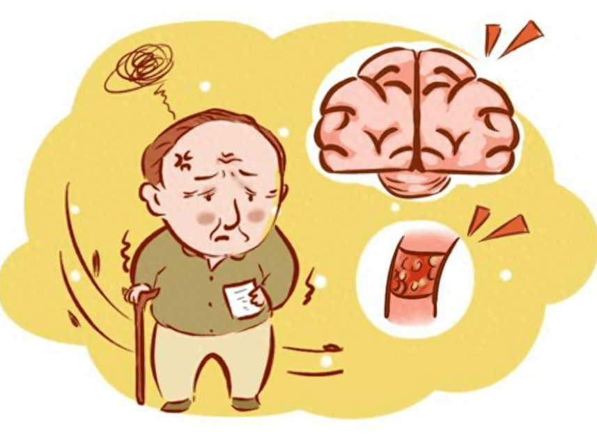 老年痴呆是发生于老年和老年前期,以进行性认知功能障碍和行为损害为