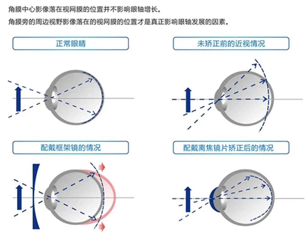 离焦镜片,你知道多少呢?_控制_效果_防控
