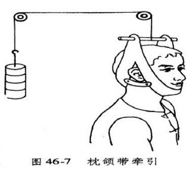 正畸三角牵引示意图图片