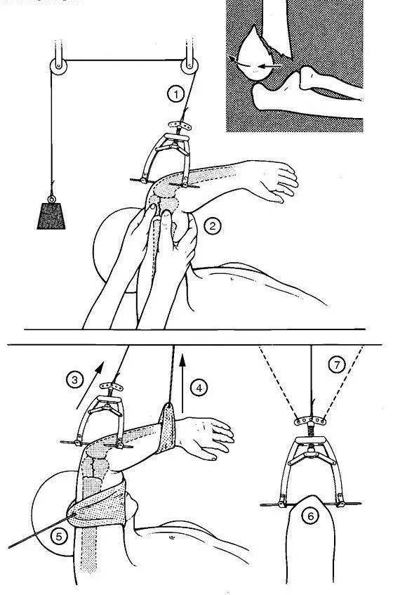 腰椎牵引示意图图片