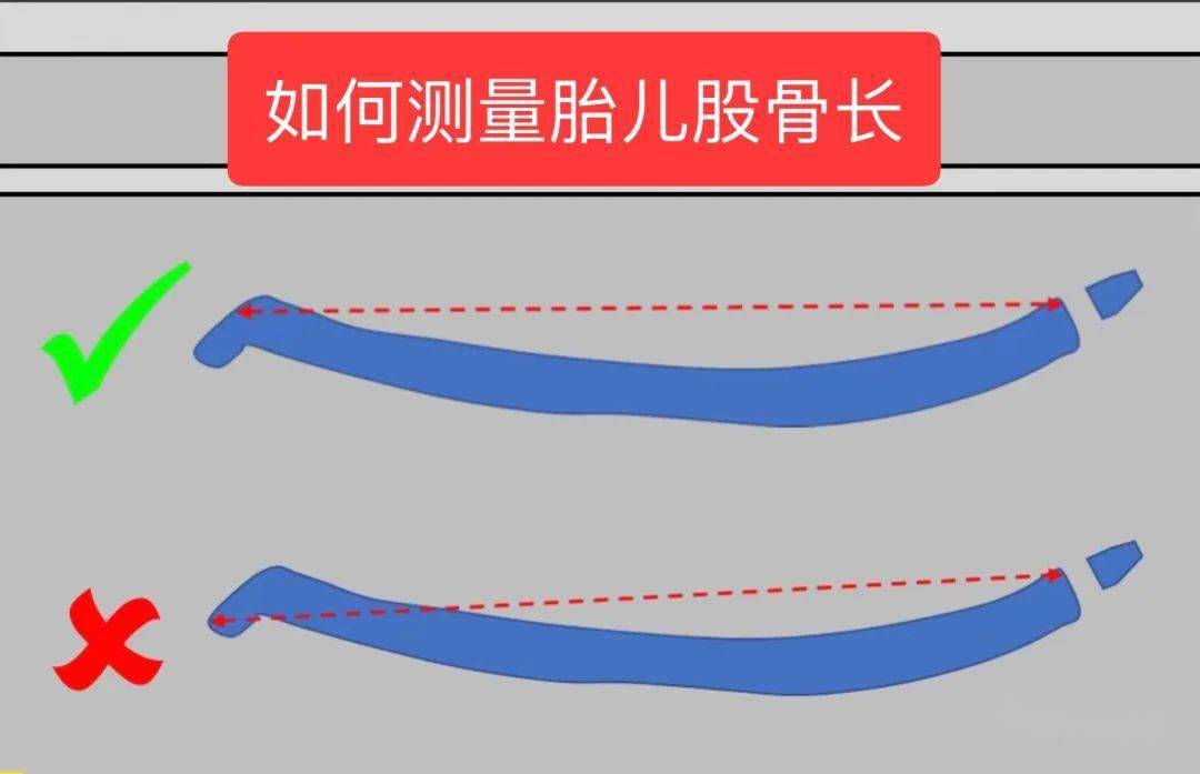 如何正确测量胎儿股骨长