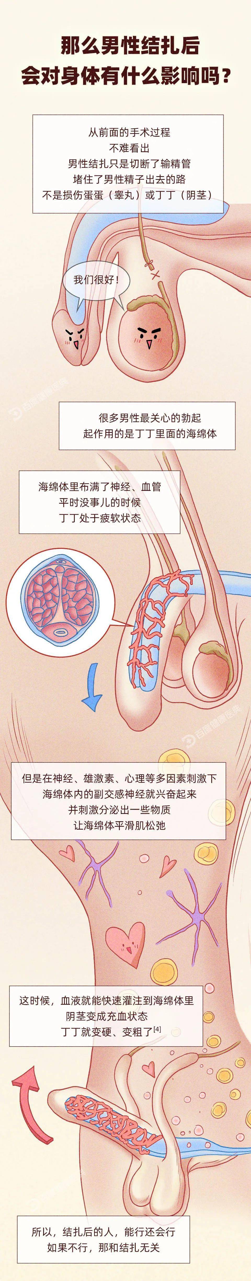 男性绝育手术图片