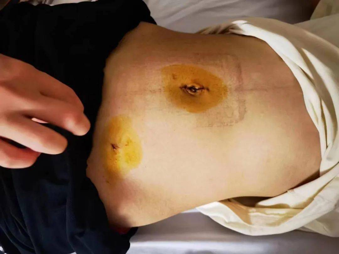 畸胎瘤手术疤痕图片图片