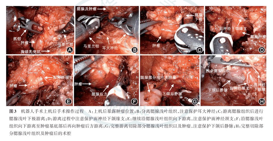 腮腺混合瘤手术后图片图片