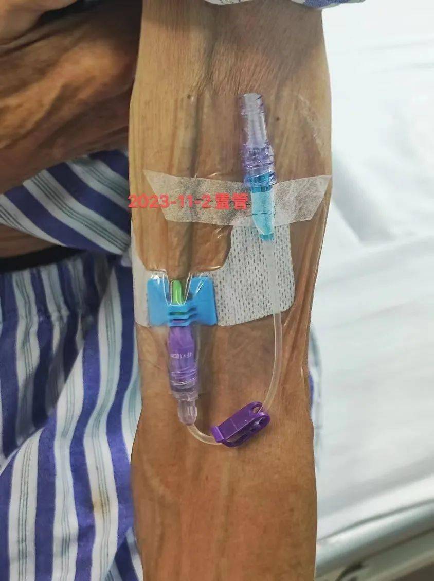 市五院开展首例迷你中线导管置入术_患者_吕诗敏_静脉