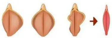 [小阴唇]是指位于大阴唇内侧的一对薄褶皱q,通常长4~5cm,厚0.5cm.