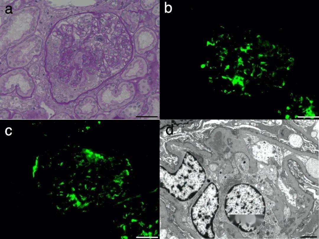 肾穿免疫荧光图片