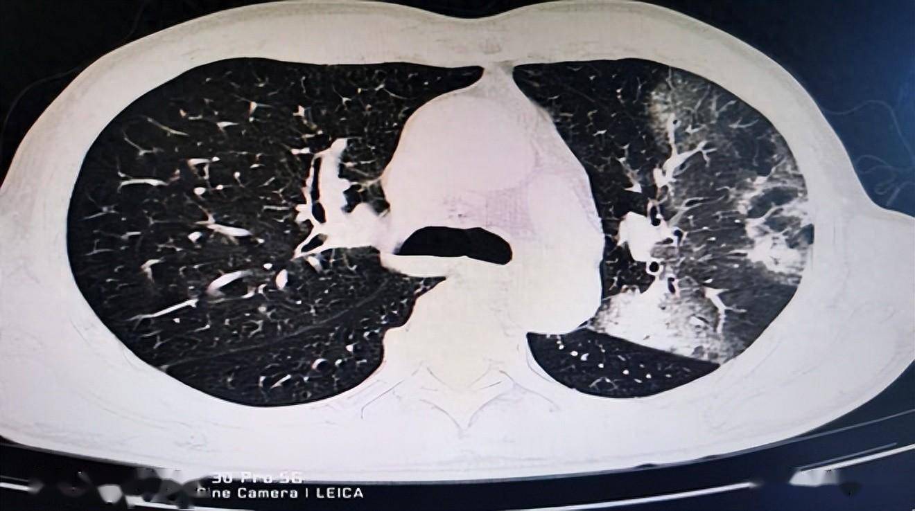 常德市第二人民医院成功救治一例罕见鹦鹉热肺炎患者_治疗_鸟类_进行