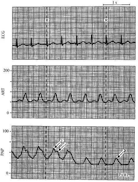 循环监测 | 心脏瓣膜病的血流动力学表现_曲线_患者_二尖瓣