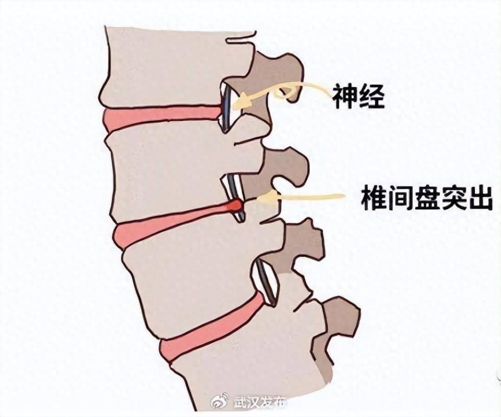 椎间盘突出图片及位置图片