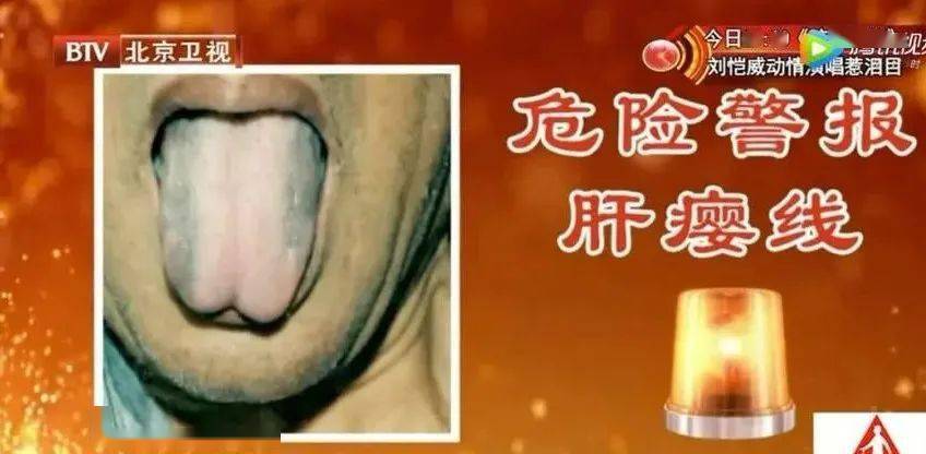 其后,王氏榕平专门做了"原发性肝癌的肝瘿线与血液流变学关系初探"一