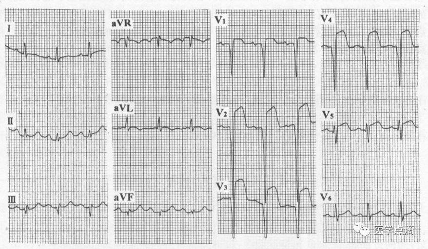 心电图v1到v6图片