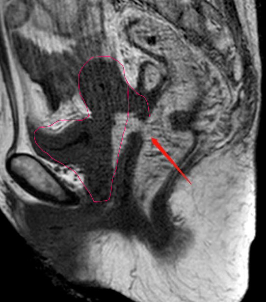 介入微创术前ct患者女,71岁,子宫恶性肿瘤3年,直肠阴道瘘1月,无法耐受