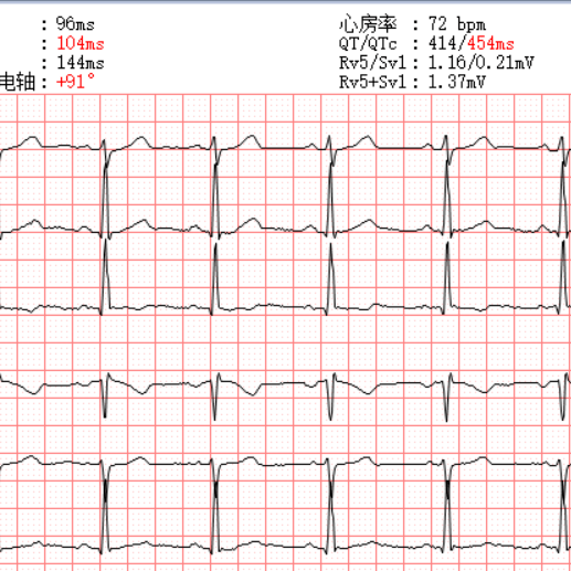 心电轴右偏心电图表现图片