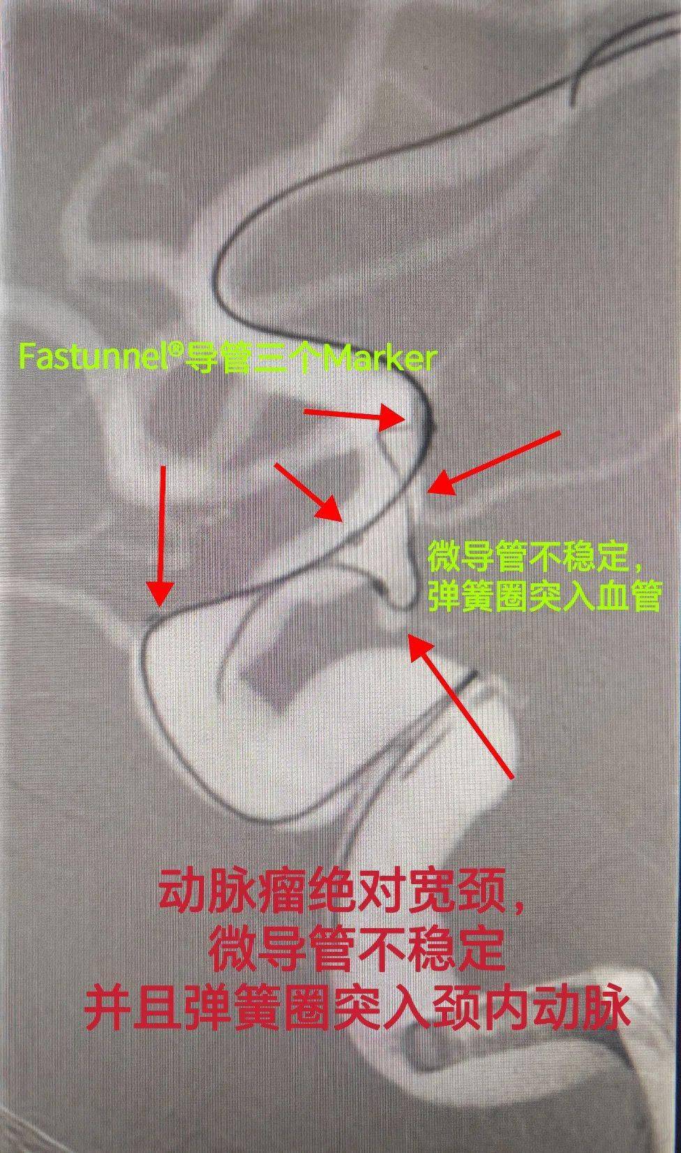 fastunnel03輸送型球囊擴張導管不用撤出,通過栓塞微導管輸送首枚