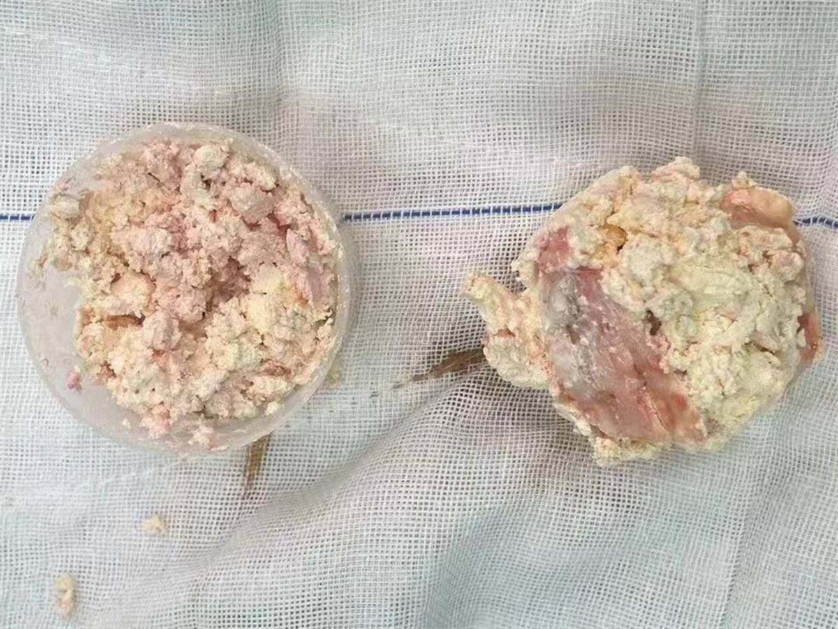 痛风石是人体内的尿酸浓度过高,尿酸盐结晶在骨关节周围产生沉积的