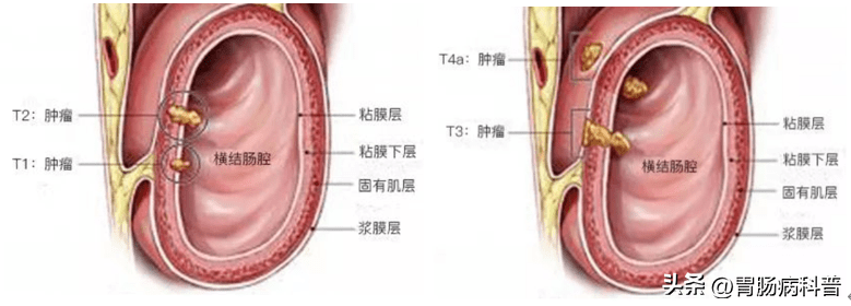 結直腸癌tnm分期圖譜_淋巴結_腫瘤_階段