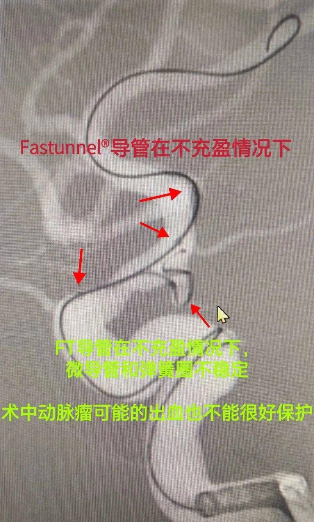 fastunnel03輸送型球囊擴張導管不用撤出,通過栓塞微導管輸送首枚