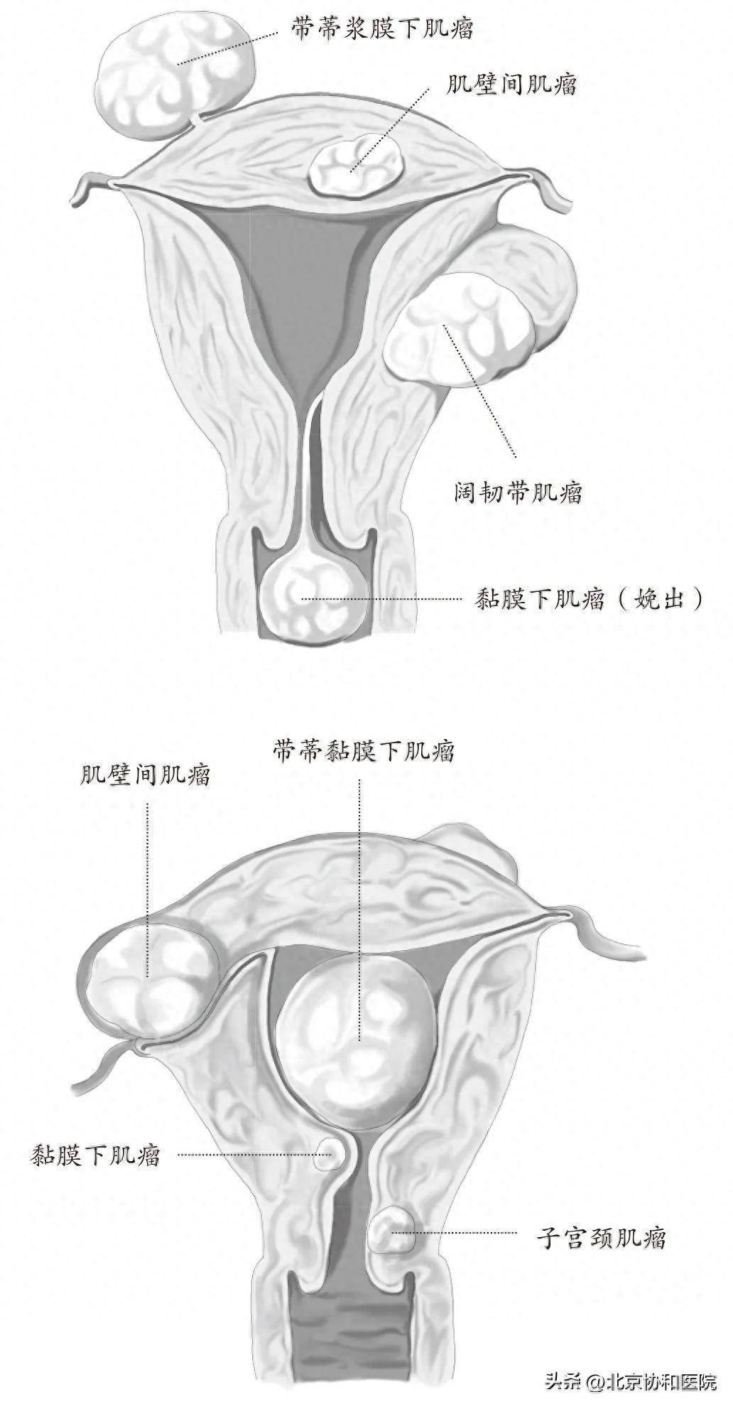 子宫韧带侧面图图片