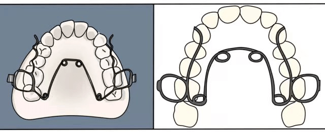 几乎每个不拔牙排齐的病例,只要稍微有拥挤,常规都要使用口外弓.