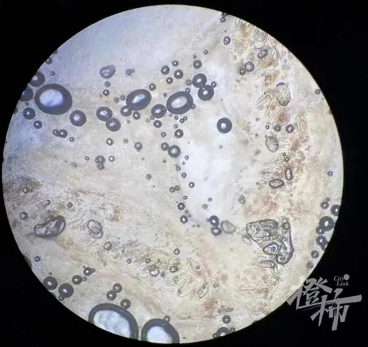 在显微镜下找到了疥虫,丁女士和朱古力确诊为疥疮!