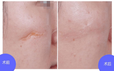 【科普】瘢痕那些事_治疗_皮肤_外伤