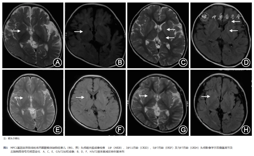 【神经系统疾病研究】线粒体丙酮酸载体缺陷症3例并文献复习