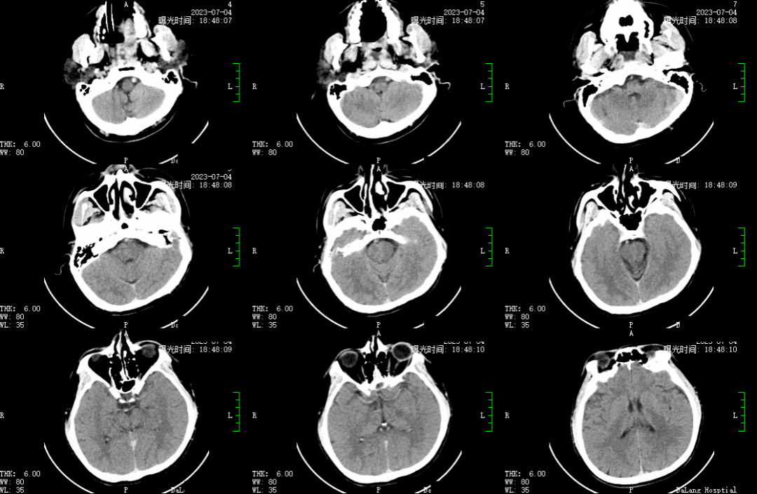 頭顱ct未見明顯出血.我院無dyna ct,留置管鞘到ct室複查頭顱ct.