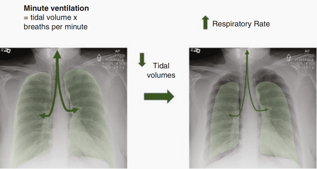 使用低潮氣量通氣的患者需要更高的呼吸頻率來維持呼吸通氣量.