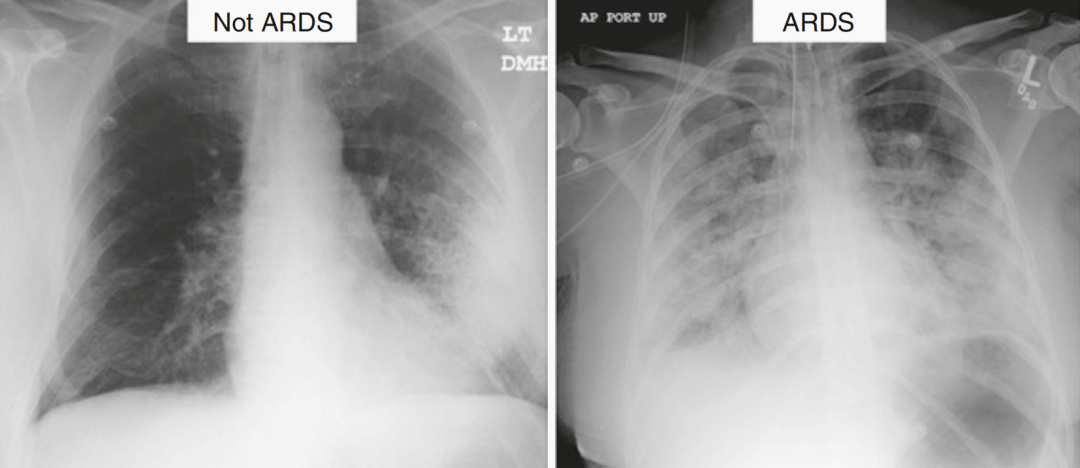 基础知识 | 一文理解ards的机械通气基础_pplat_cmh_患者