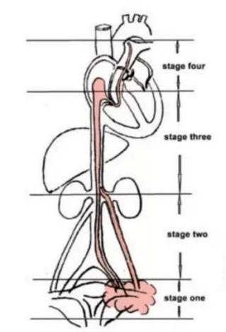 静脉内平滑肌瘤病_临床_肿瘤_治疗