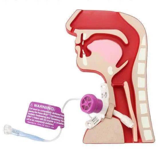 【特色诊疗】气管切开患者的福音——吞咽说话瓣膜_康复医院_重症