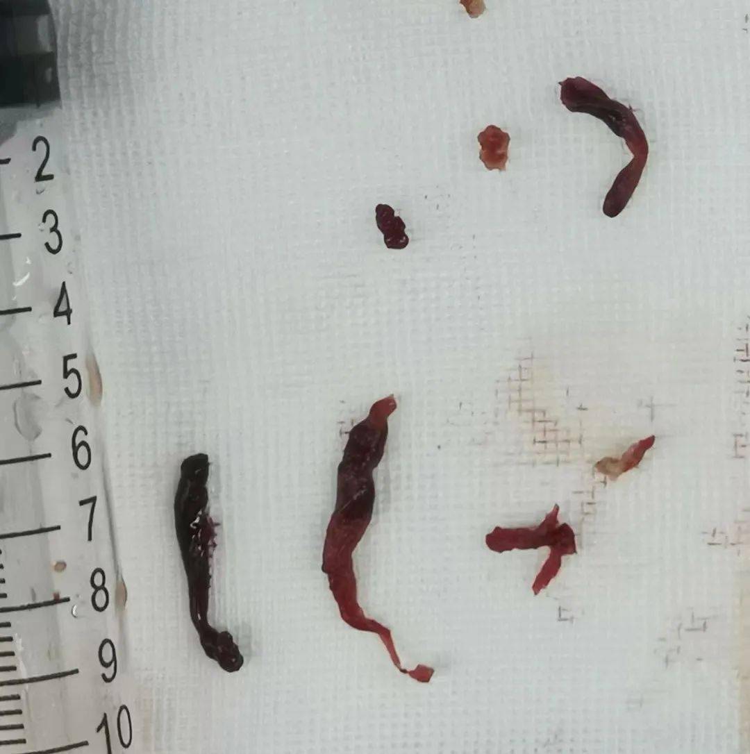 肚疼便血2天,医生从他血管里掏出大量血栓!请把这3条忠告转给所有人.