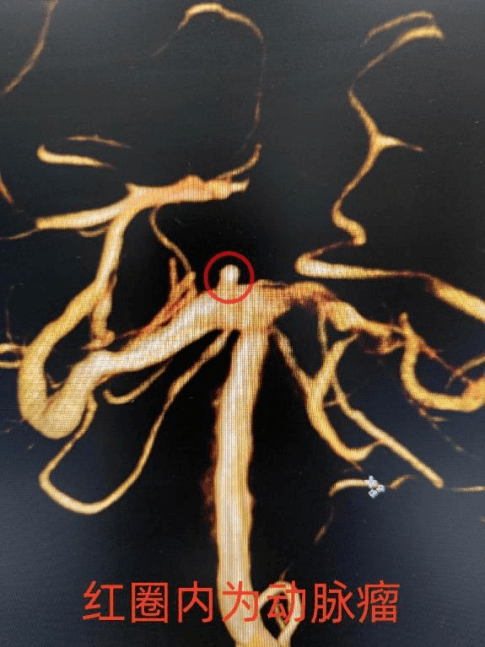 通過這次造影,王阿姨被診斷為左側眼動脈段多發動脈瘤,右側頸內動脈